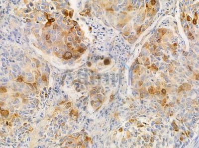 Truncated steroid 21-hydroxylase Antibody - DF10130 at 1/100 staining human lung squamous cell carcinoma by IHC-P.