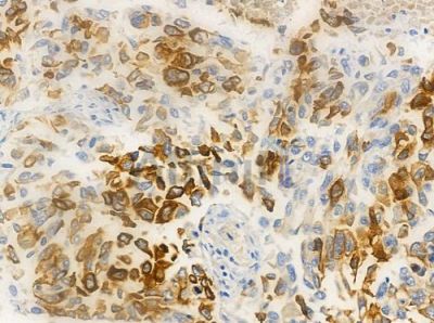 Truncated steroid 21-hydroxylase Antibody - DF10130 at 1/100 staining human lung squamous cell carcinoma by IHC-P.