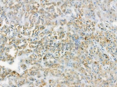 NEK3 Antibody - DF10137 at 1/100 staining human renal cell carcinoma by IHC-P.