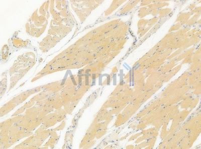 IL27RA Antibody - DF10160 at 1/100 staining human tongue carcinoma by IHC-P.