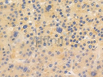 IL27RA Antibody - DF10160 at 1/100 staining human hepatocellular carcinoma by IHC-P.