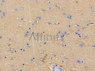ECM1 Antibody - DF10163 at 1/100 staining human glioblastoma by IHC-P.