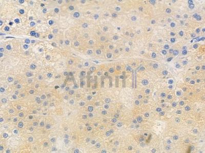 FCRL4 Antibody - DF10173 at 1/100 staining human hepatocellular carcinoma by IHC-P.