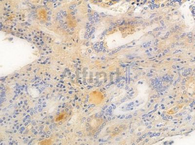 FCRL4 Antibody - DF10173 at 1/100 staining human thyroid carcinoma by IHC-P.