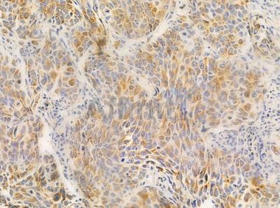 RLN3 Antibody - DF10177 at 1/100 staining human lung squamous cell carcinoma by IHC-P.