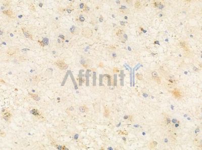 RLN3 Antibody - DF10177 at 1/100 staining human astrocytoma by IHC-P.