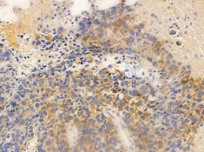 RLN3 Antibody - DF10177 at 1/100 staining human glioblastoma by IHC-P.