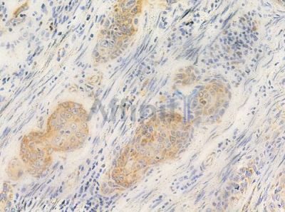 RLN3 Antibody - DF10177 at 1/100 staining human esophageal carcinoma by IHC-P.