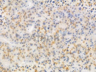OR10H5 Antibody - DF10224 at 1/100 staining human hepatocellular carcinoma by IHC-P.