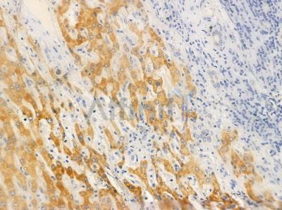 OR10H5 Antibody - DF10224 at 1/100 staining human hepatocellular carcinoma by IHC-P.