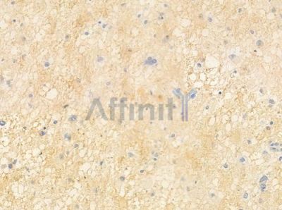 OR13J1 Antibody - DF10225 at 1/100 staining human astrocytoma by IHC-P.