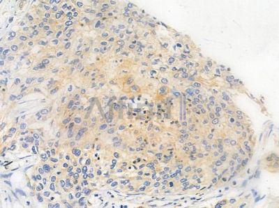 OR4C46 Antibody - DF10226 at 1/100 staining human cervical carcinoma by IHC-P.