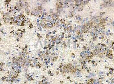 OR4F15 Antibody - DF10227 at 1/100 staining human melanoma by IHC-P.