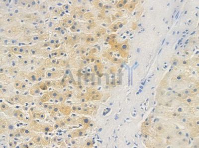 OR10W1 Antibody - DF10236 at 1/100 staining human hepatocellular carcinoma by IHC-P.
