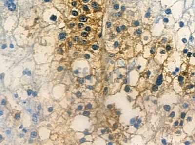 OR2G6 Antibody - DF10246 at 1/100 staining human hepatocellular carcinoma by IHC-P.