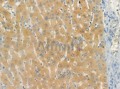 OR2L13 Antibody - DF10247 at 1/100 staining human hepatocellular carcinoma by IHC-P.