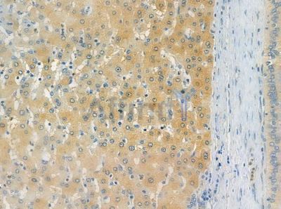OR Antibody - DF10250 at 1/100 staining human hepatocellular carcinoma by IHC-P.
