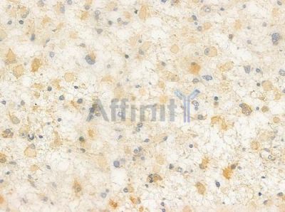 P2RY12 Antibody - DF10263 at 1/100 staining human astrocytoma by IHC-P.