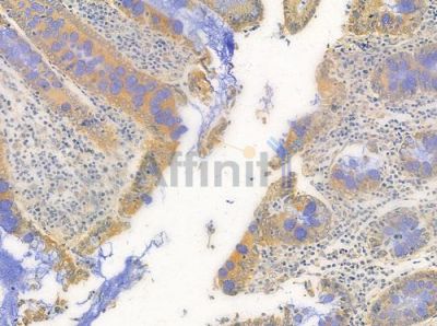 P2RY12 Antibody - DF10263 at 1/100 staining human colon carcinoma by IHC-P.