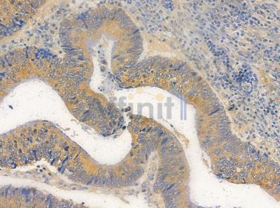 P2RY12 Antibody - DF10263 at 1/100 staining human colon carcinoma by IHC-P.