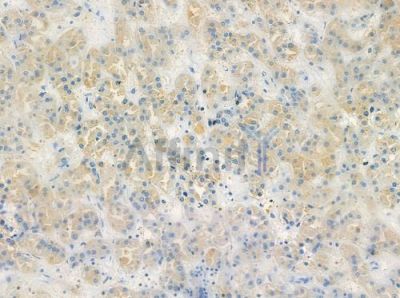 OR52N2 Antibody - DF10288 at 1/100 staining human renal cell carcinoma by IHC-P.