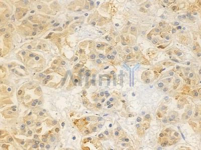 OR52N5 Antibody - DF10289 at 1/100 staining human renal cell carcinoma by IHC-P.