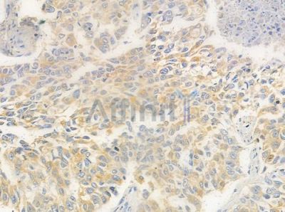 OR56A4/5 Antibody - DF10292 at 1/100 staining human lung squamous cell carcinoma by IHC-P.