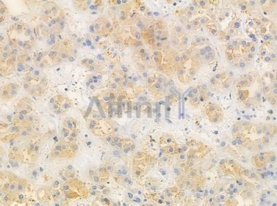OR2L2 Antibody - DF10295 at 1/100 staining human renal cell carcinoma by IHC-P.