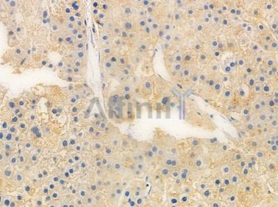 OR2L2 Antibody - DF10295 at 1/100 staining human hepatocellular carcinoma by IHC-P.