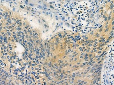 OR4A47 Antibody - DF10296 at 1/100 staining human cervical carcinoma by IHC-P.