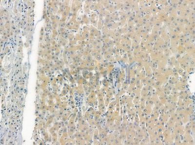 OR4A47 Antibody - DF10296 at 1/100 staining human hepatocellular carcinoma by IHC-P.