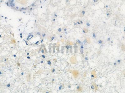 TAS2R47 Antibody - DF10304 at 1/100 staining human astrocytoma by IHC-P.