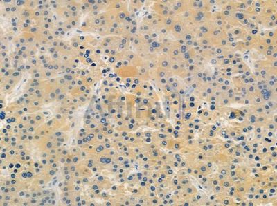 TAS2R47 Antibody - DF10304 at 1/100 staining human hepatocellular carcinoma by IHC-P.