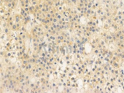 HCG39951 Antibody - DF10306 at 1/100 staining human hepatocellular carcinoma by IHC-P.
