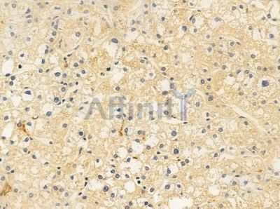 HCG39951 Antibody - DF10306 at 1/100 staining human hepatocellular carcinoma by IHC-P.