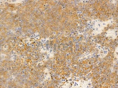 HCG2040518 Antibody - DF10307 at 1/100 staining human lung squamous cell carcinoma by IHC-P.