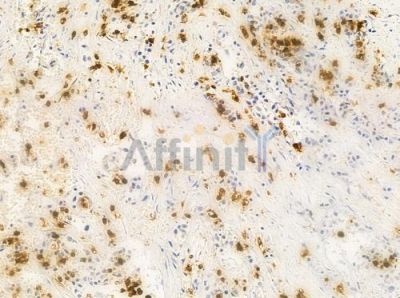 HCG2040518 Antibody - DF10307 at 1/100 staining human breast carcinoma by IHC-P.