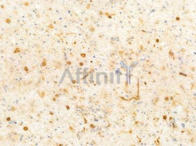 HCG2040518 Antibody - DF10307 at 1/100 staining human astrocytoma by IHC-P.