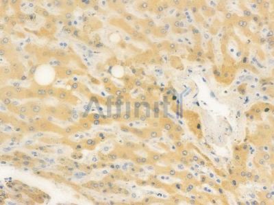 FBXL20 Antibody - DF15694 at 1/100 staining human hepatocellular carcinoma by IHC-P.