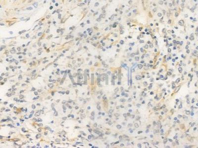 FCN1 Antibody - DF15717 at 1/100 staining human Hodgkin lymphoma by IHC-P.