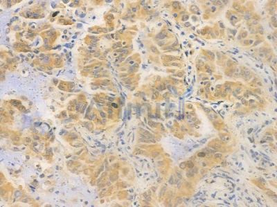 SCAF11 Antibody - DF15740 at 1/100 staining human lung adenocarcinoma by IHC-P.