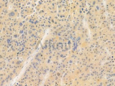KAZN Antibody - DF15743 at 1/100 staining human hepatocellular carcinoma by IHC-P.