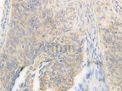 KCNJ1 Antibody - DF15757 at 1/100 staining human prostate carcinoma by IHC-P.