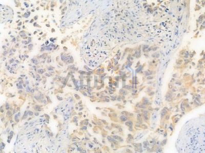 KCNJ1 Antibody - DF15757 at 1/100 staining human lung squamous cell carcinoma by IHC-P.