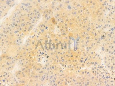 ASB6 Antibody - DF15759 at 1/100 staining human hepatocellular carcinoma by IHC-P.