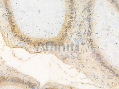 CLEC2A Antibody - DF15762 at 1/100 staining human testicular cancer by IHC-P.