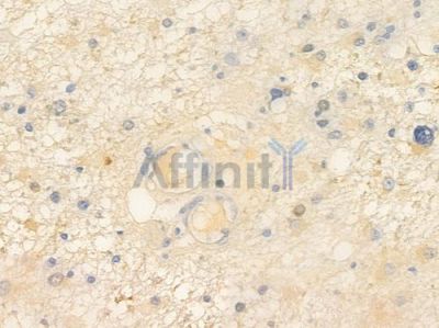 WDYHV1 Antibody - DF15786 at 1/100 staining human astrocytoma by IHC-P.
