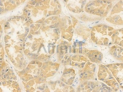 SMG8 Antibody - DF15802 at 1/100 staining human renal cell carcinoma by IHC-P.