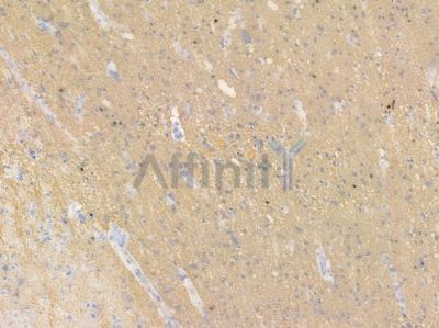 ANO10 Antibody - DF15809 at 1/100 staining human glioblastoma by IHC-P.