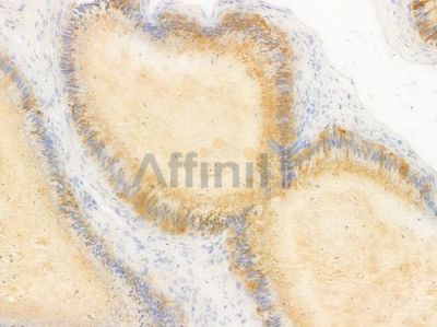 NAA30 Antibody - DF15817 at 1/100 staining human testicular cancer by IHC-P.